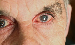 Cataract Surgery Des Plaines IL